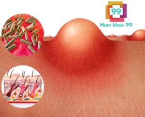 cách trị mụn cậu nhỏ tại nhà