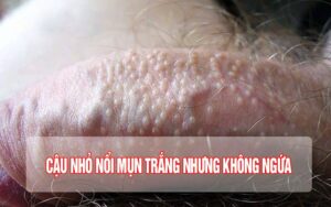 cậu nhỏ nổi mụn trắng không ngứa