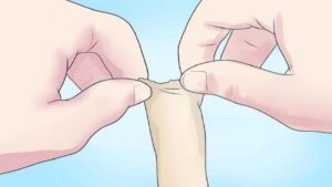 cách khắc phục dài bao quy đầu tại nhà hiệu quả