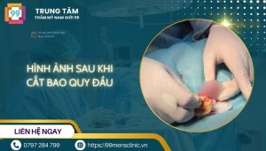 Hình ảnh sau khi cắt bao quy đầu